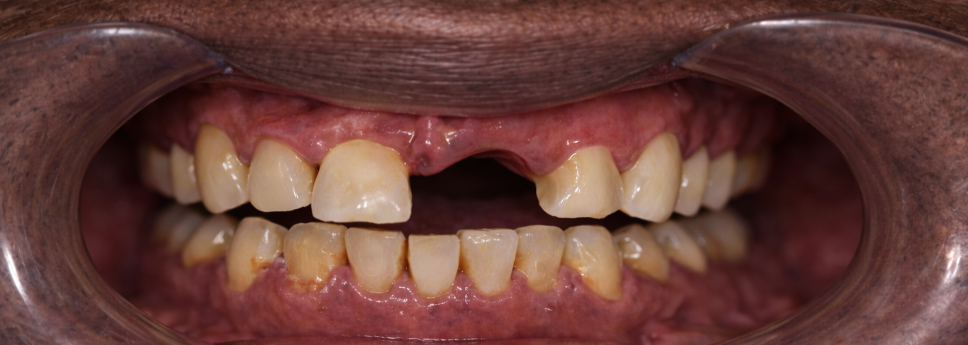 Prima del trattamento impianti dentali